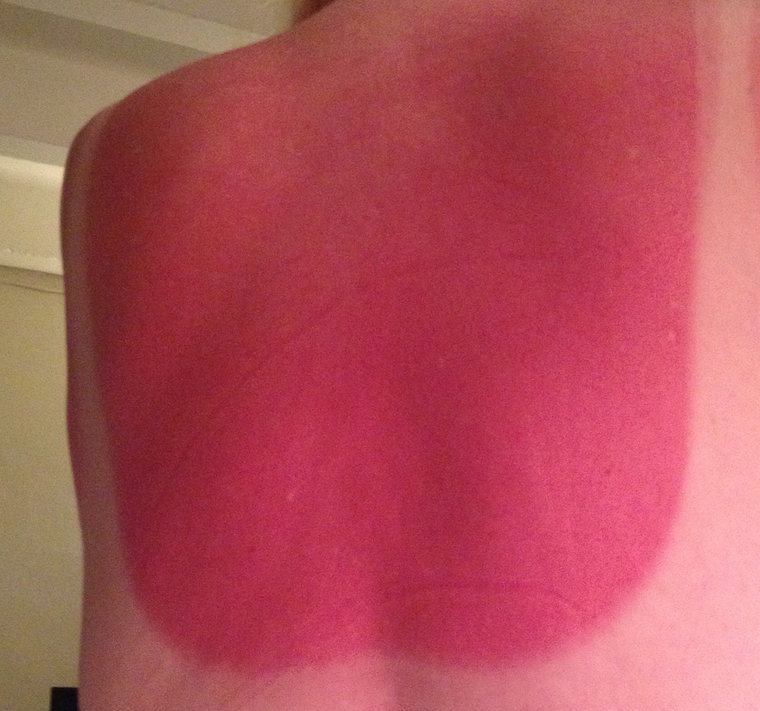 worst sunburn ever